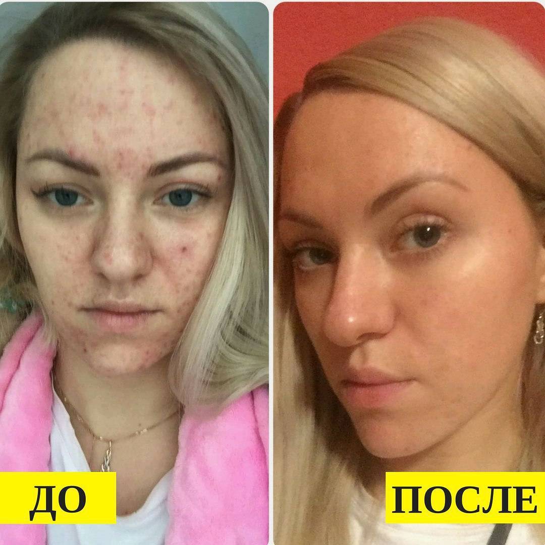 Чистка кожи лица у косметолога в Москве – цена в салоне рядом с Тропарева в  ЮЗАО